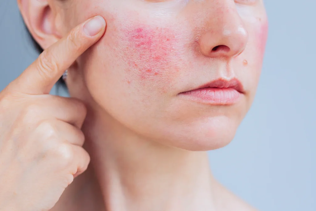 Rosacea at AARx