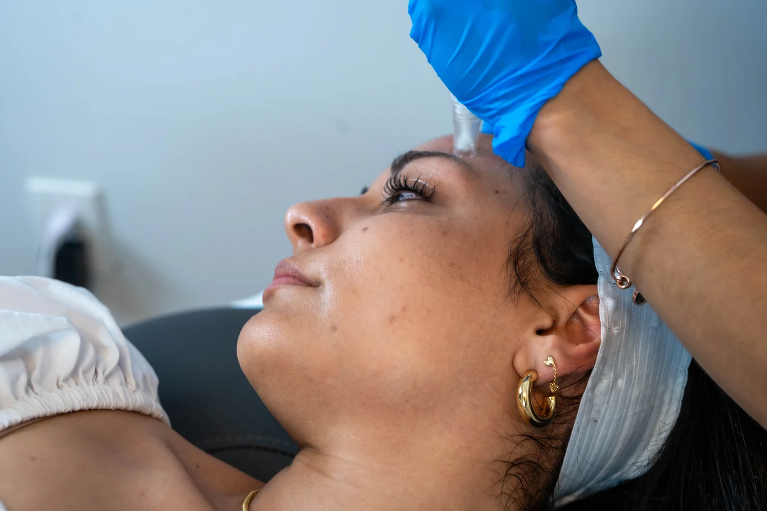 SkinPen microneedling treatment at AARx